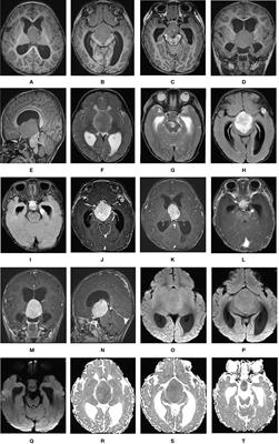 Case Report: ALK-Positive Histiocytosis With KIF5B-ALK Fusion in Cerebrum-Disseminated Lesions in a Child